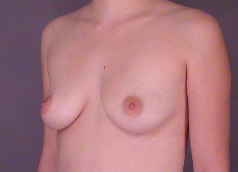 Breast Augmentation before and after photo