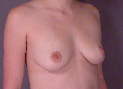 Breast Augmentation before and after photo