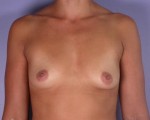 Breast Augmentation Before and after photo