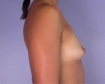 Breast Augmentation Before and after photo