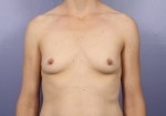 Breast Augmentation Before and after photo