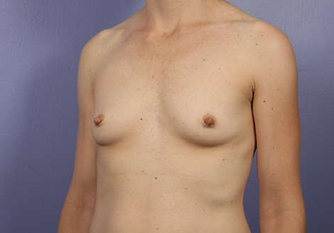 Breast Augmentation before and after photo