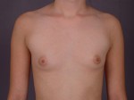 Breast Augmentation Before and after photo