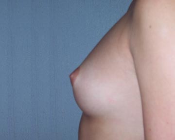 Breast Augmentation before and after photo