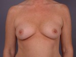 Breast Augmentation Before and after photo