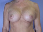 Breast Augmentation Before and after photo