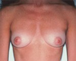 Breast Augmentation Before and after photo