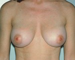 Breast Augmentation Before and after photo