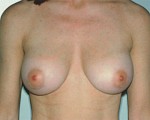 Breast Augmentation