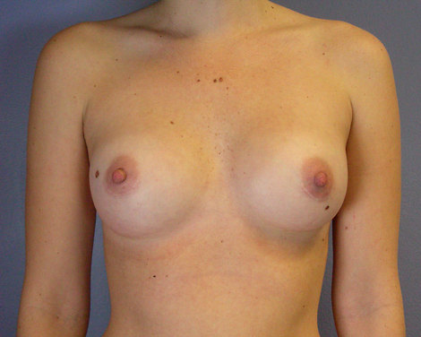 Breast Augmentation before and after photo