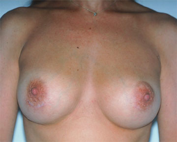 Breast Augmentation before and after photo