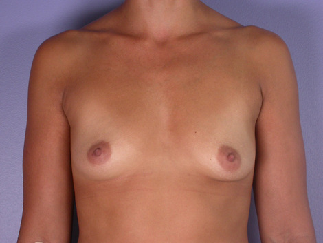 Breast Augmentation before and after photo