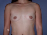 Breast Augmentation Before and after photo