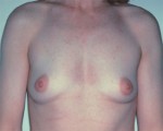 Breast Augmentation Before and after photo