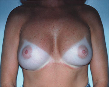 Breast Augmentation before and after photo