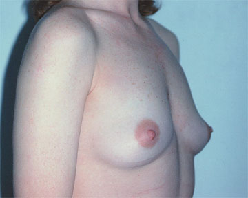 Breast Augmentation before and after photo