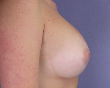 Breast Augmentation before and after photo