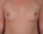 Breast Augmentation Before and after photo