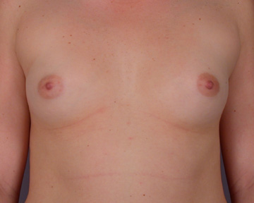 Breast Augmentation before and after photo