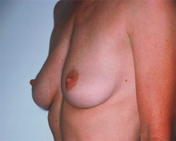 Breast Augmentation before and after photo