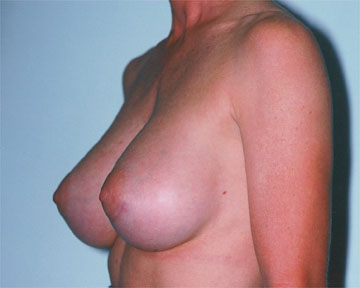 Breast Augmentation before and after photo