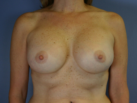 Breast Augmentation before and after photo