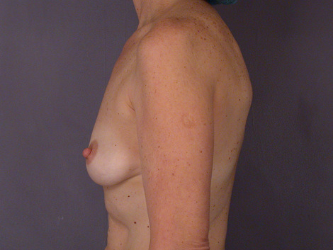 Breast Augmentation before and after photo