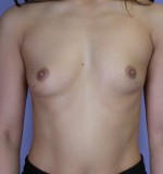 Breast Augmentation