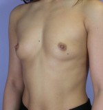 Breast Augmentation