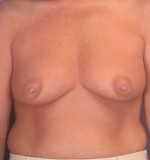 Breast Augmentation