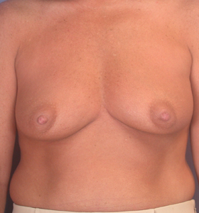 Breast Augmentation before and after photo