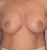 Breast Augmentation