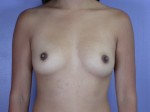 Breast Augmentation