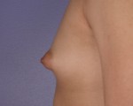 Breast Augmentation