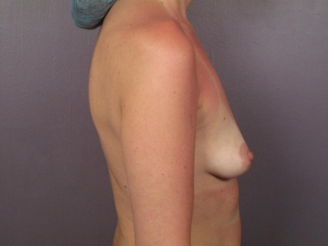 Breast Augmentation before and after photo