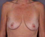 Breast Augmentation