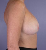 Breast Augmentation