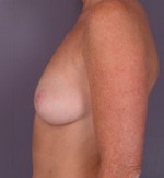 Breast Augmentation Before and after photo