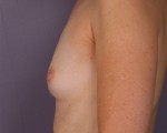 Breast Augmentation Before and after photo
