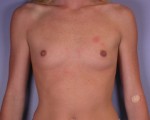 Breast Augmentation