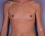 Breast Augmentation