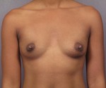 Breast Augmentation