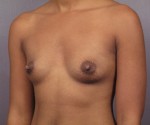 Breast Augmentation