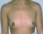 Breast Augmentation Before and after photo