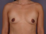 Breast Augmentation