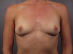 Breast Augmentation