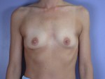 Breast Augmentation