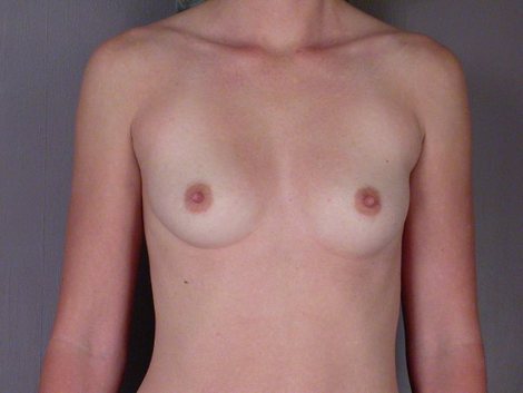 Breast Augmentation before and after photo