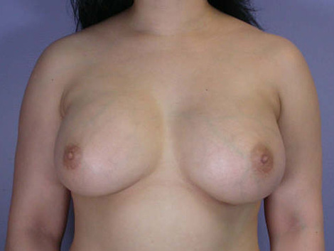 Breast Augmentation before and after photo