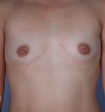 Breast Augmentation Before and after photo